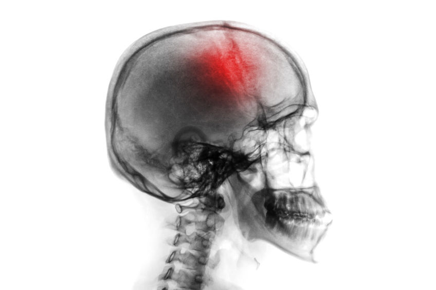 Common Causes for Brain Injuries